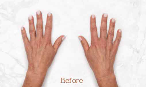 Hands before a hand rejuvenation treatment showing wrinkles and age spots