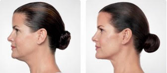 Kybella before and after