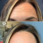 botox before and after image showing woman's forehead