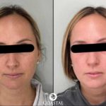 Before and after photos of woman that had a chemical peel done at Coastal Aesthetics