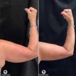 Before and After images showing the toning of a womans arm after a coolsculpting treatment at Coastal Aesthetics
