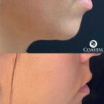 Before and after images showing woman who had a filler treatment done at Coastal Aesthetics