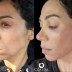 Before and after images showing woman who had a filler treatment at Coastal Aesthetics