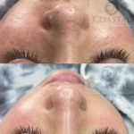Before and after photos showing woman that had a Hydrafacial at Coastal Aesthetics