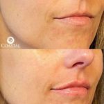 Before and after images showing woman who had lip filler done at Coastal Aesthetics