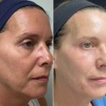 Before and after images showing woman who had a microneedling treatment