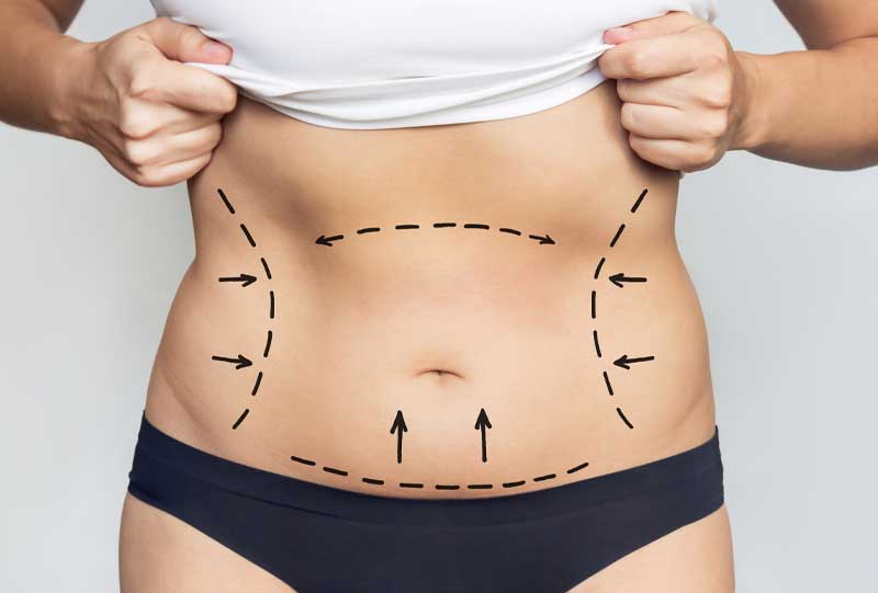 a womans stomach with markings on it to show where fat reduction is wanted.