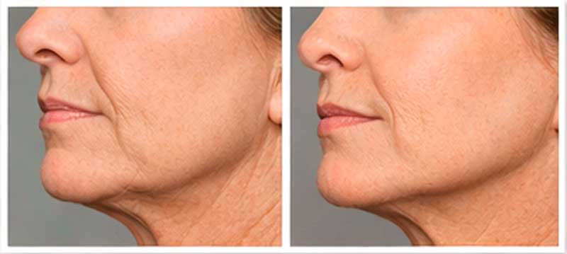Before and after rendering to show neck skin tightening on older woman.
