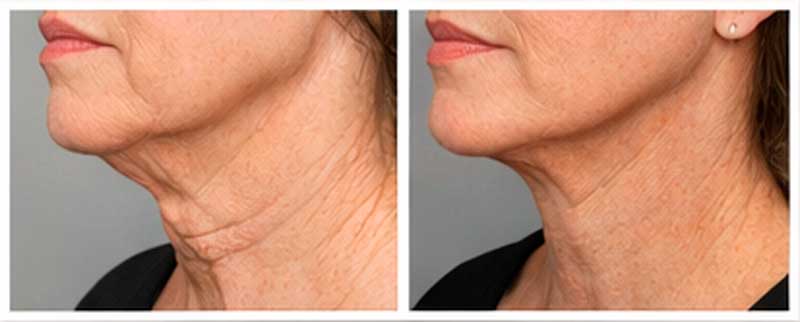 Before and after rendering to show neck skin tightening on older woman.