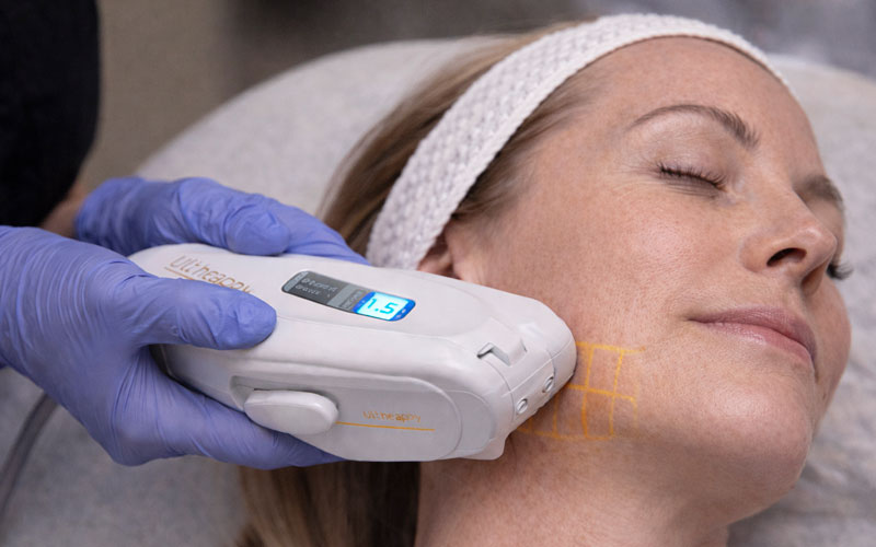 Technician preforming the Ultherapy Prime non surgical skin lifting on patient.